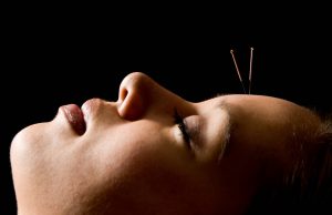 akupunktur yintan